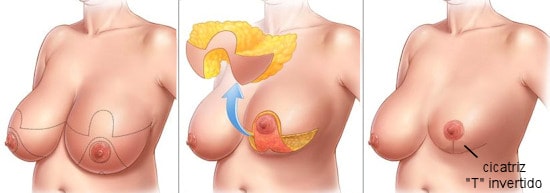 mamoplastia redutora